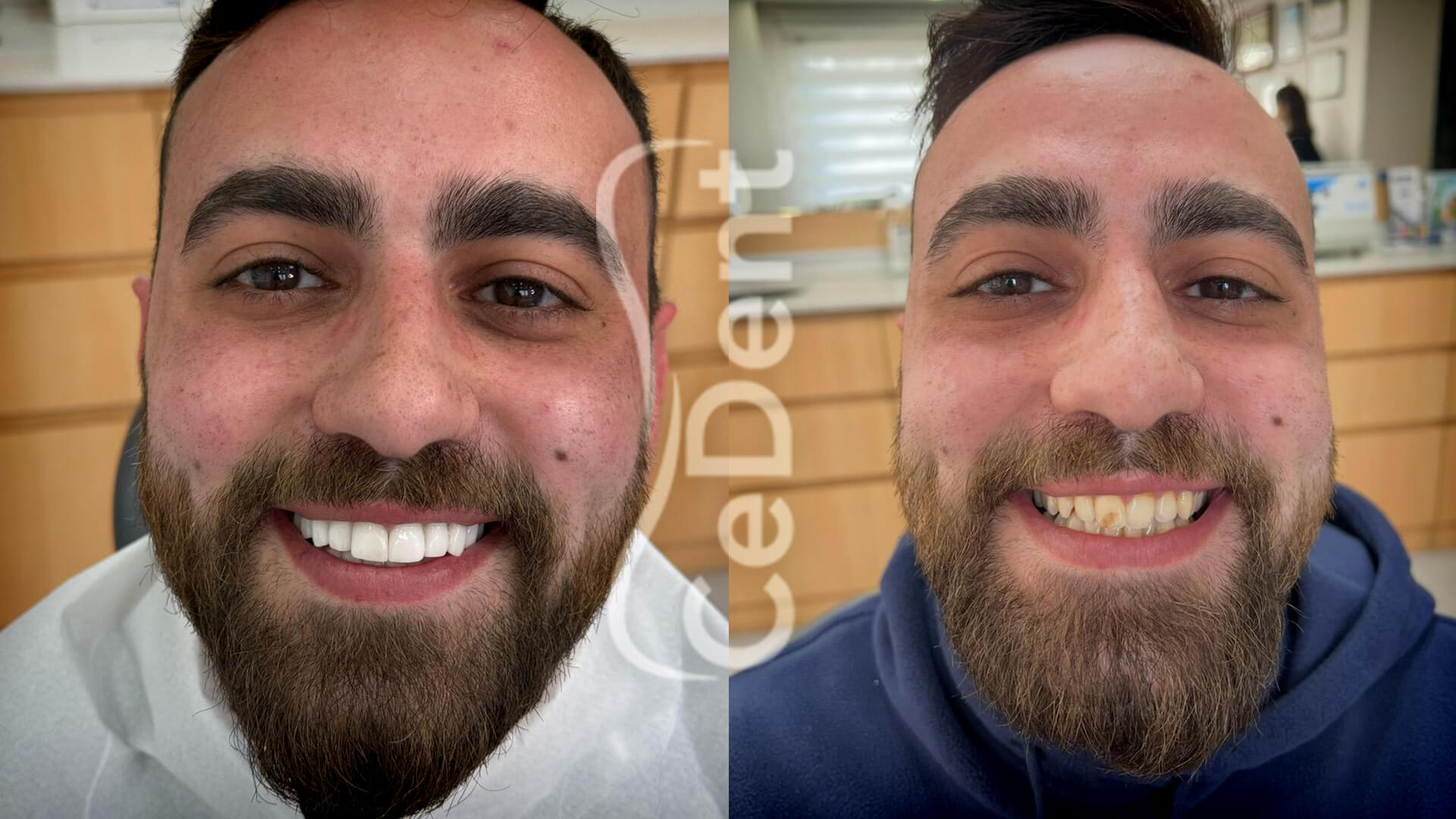 Cedent-oncesi-sonrasi-slider-3