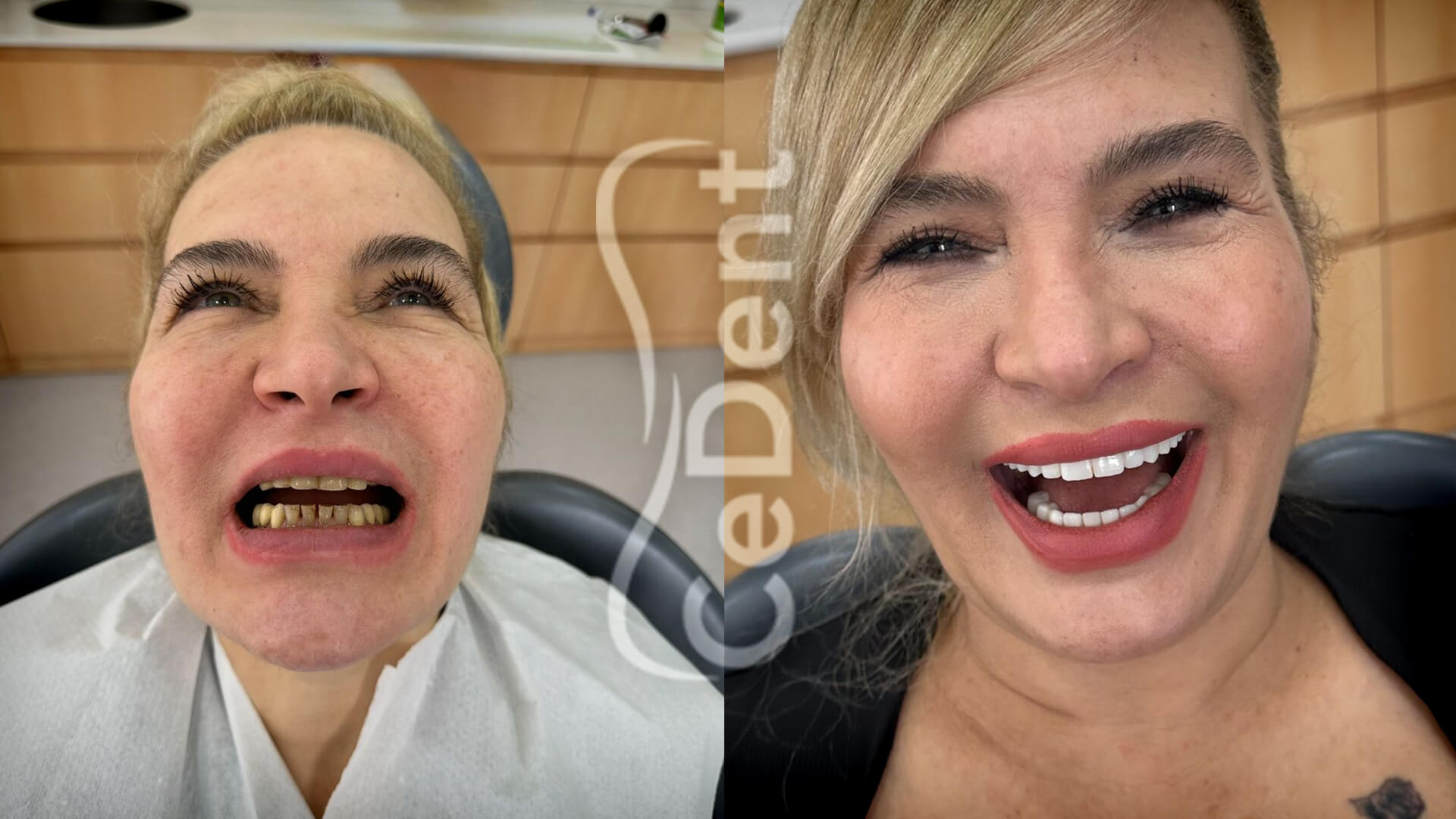 Cedent-oncesi-sonrasi-slider-7