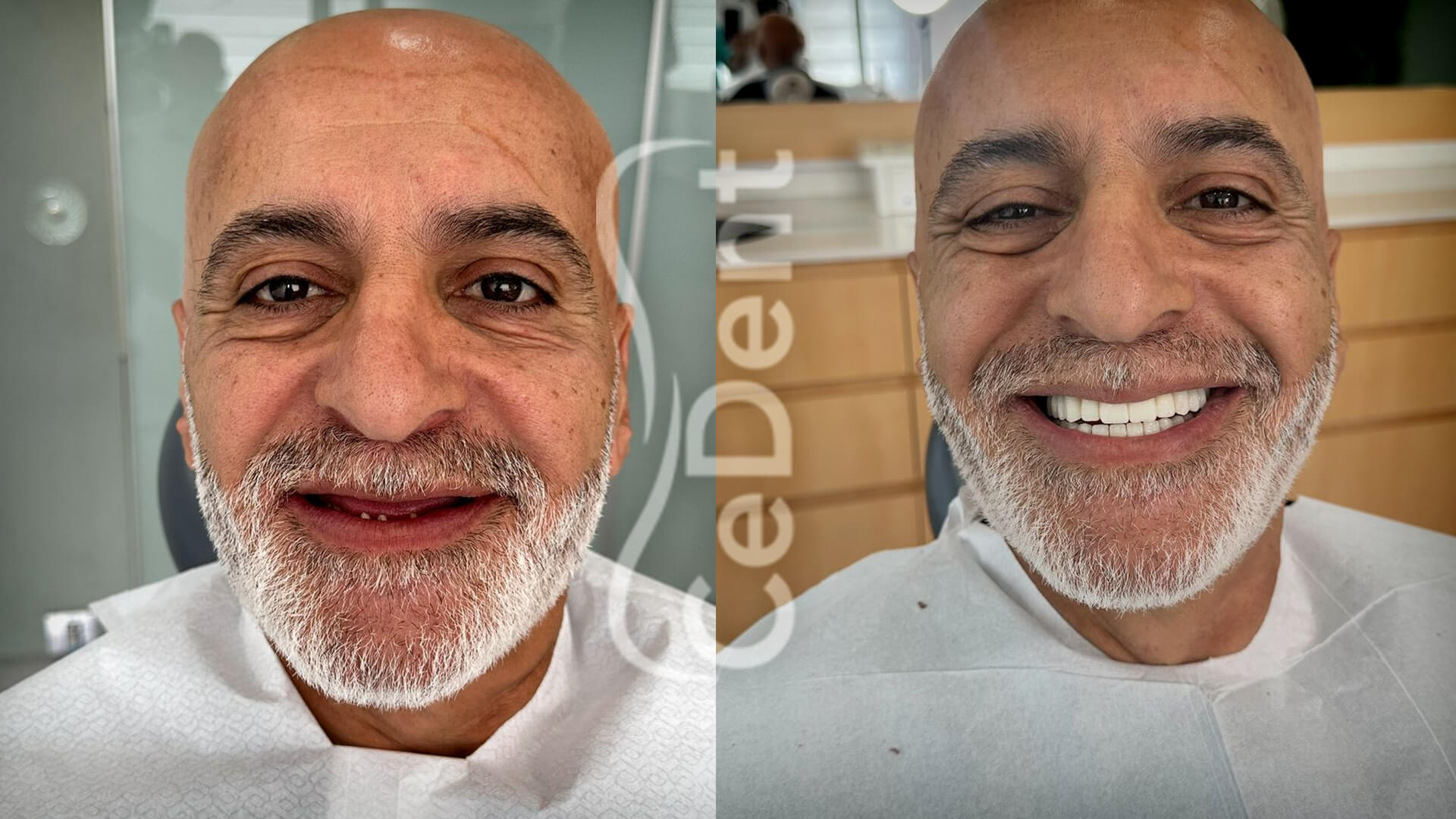 Cedent-oncesi-sonrasi-slider-8